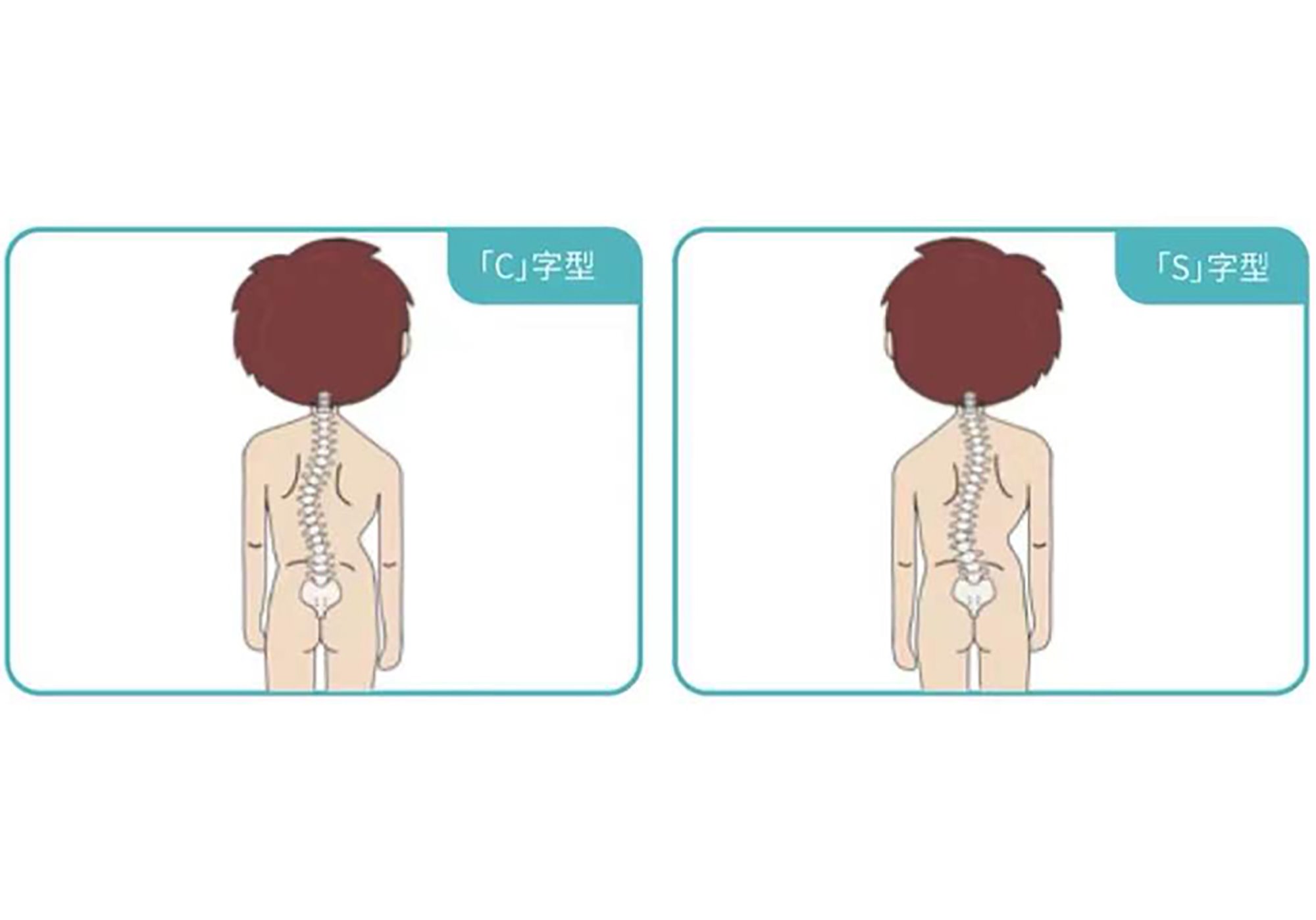 Scoliosis  diagnosis screening has been included in the routine physical examination of students in China
